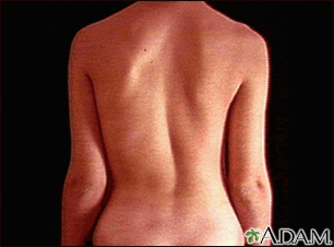 Scoliosis
