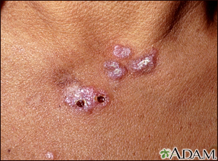Lupus, discoid - view of lesions on the chest