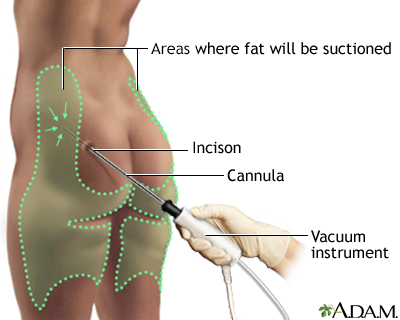 Procedure