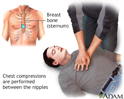 Chest compressions