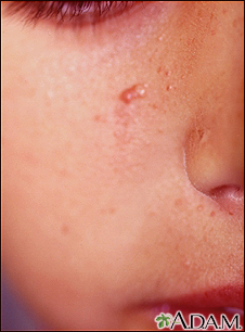 Tuberous sclerosis, angiofibromas - face