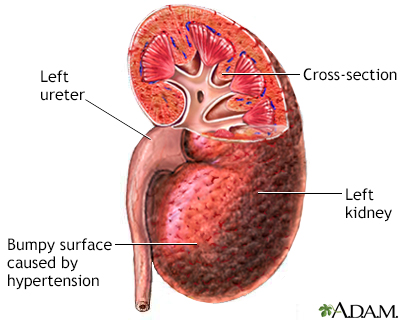 Hypertensive kidney