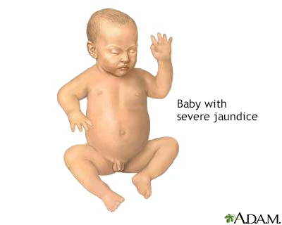 Infant jaundice