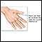 Wart removal