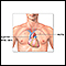 Heart transplant - series