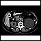 Kidney cyst with gallstones - CT scan