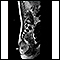 Teratoma - MRI scan