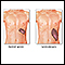 Splenomegaly
