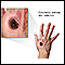 Cutaneous Anthrax