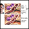 Middle ear infection (otitis media)