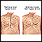 Heart bypass surgery incision
