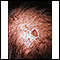 Actinic keratosis on the scalp