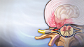 Herniated disk