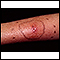 Cellulitis