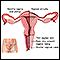 Vaginal atrophy