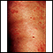 Hives (urticaria) on the trunk