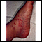 Henoch-Schonlein purpura on an infant's foot