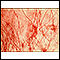 Crab lice