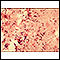 Pneumococcal pneumonia